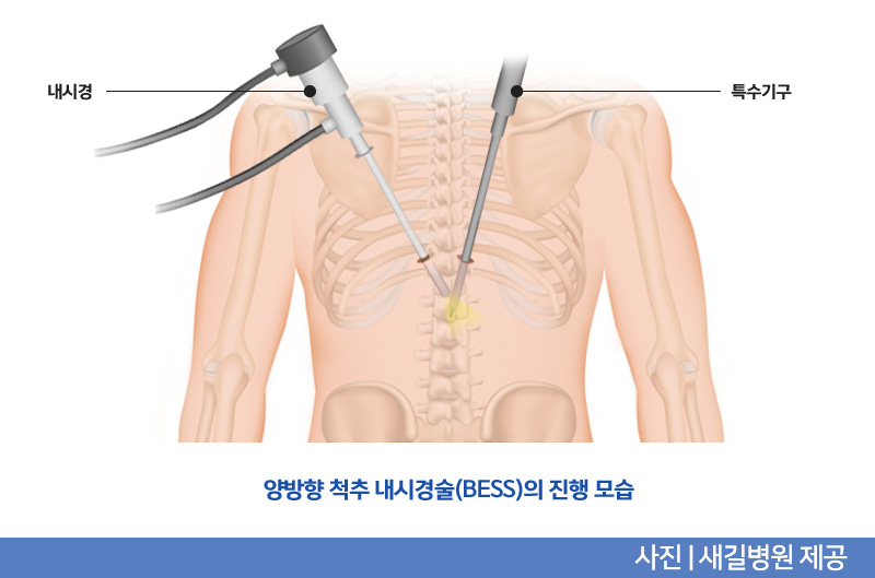 새길병원_이미지_양방향척추내시경(2).jpg